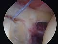 SLAP Repair Arthroscopic ??????????? ??????????????? ???????