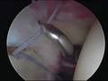 SLAP Repair Arthroscopic เอ็นไหล่ฉีก ผ่าตัดส่องกล้อง ปวดไหล่