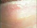 DEBBIE'S LASIK EYE SURGERY
