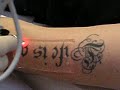 Laser Tattooentfernung bei Laserinstitut Dermamea in Esslingen aN