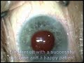 IOL Exchange / lens / Cataract Surgery by Uday Devgan MD IOL Exchange / lens / Cataract Surgery by Uday Devgan MD