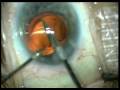 Cataract Surgery - IOL Exchange Cataract Surgery - IOL Exchange