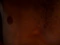 asthma attack with Pectus excavatum (dangerous)2