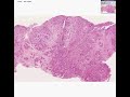 Histopathology Lung, pleura--Mesothelioma