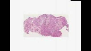 Histopathology Lung, Pleura--Mesothelioma