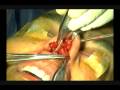 Gore-tex Noselift performed by Dr. Levi John Lansangan,MD,DBPO-HNS,FPAAS