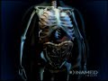 Lap-Band Surgery Animation
