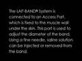 lap-band gastric proceedure