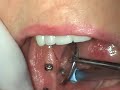 Broken abutment screw Broken abutment screw