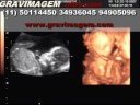 GRAVIMAGEM 97 (ULTRA-SOM DE GRAVIDEZ 3D 4D 21 SEMANAS)