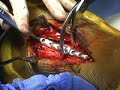 ORIF Distal Fibular Fx (sample) - www.proceduresconsult.com