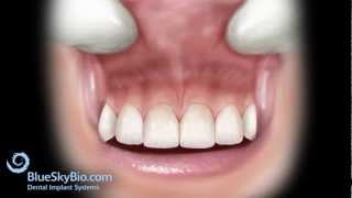 Frenectomy