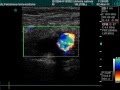 Common Femoral Vein Thrombosis And Superficial Femoral Artery Occlusion In Doppler Exam Common Femoral Vein Thrombosis And Superficial Femoral Artery Occlusion In Doppler Exam