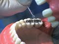 polishing amalgam.wmv