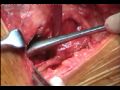 Birmingham Hip Resurfacing Surgery- Vijay Bose_Part 1 Birmingham Hip Resurfacing Surgery- Vijay Bose_Part 1