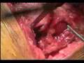 Birmingham Hip Resurfacing Surgery- Vijay Bose_Part 1
