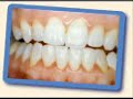 WEICHAFE-SI, ME SAQUE LOS DIENTES