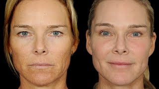 Look Refreshed and Natural - Ponytail Facelift™ - Amazing Plastic Surgery - Before and After Results