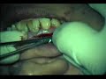 Apicoectomy (2 of 2)
