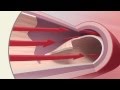 SCAD Spontaneous Coronary Artery Dissection - Mayo Clinic