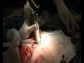 Brain Tumor Surgery, Tumor Cerebral (Thrace-Greece)
