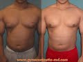 Gynecomastia Body Builder and Athlete Male Breast Reduction