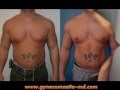 Gynecomastia Body Builder and Athlete Male Breast Reduction