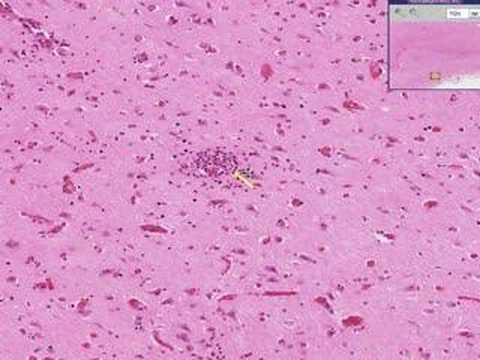 Histopathology Brain --Viral ...