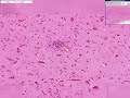 Histopathology Brain --Viral encephalitis Encephalitis