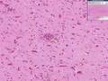 Histopathology Brain --Viral encephalitis Histopathology Brain --Viral encephalitis