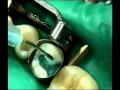 Tooth Color Filling - White Filling - Composite Resin