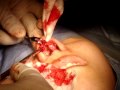 鼻尖形成術 鼻柱横切開 open rhinoplasty approach
