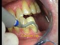 Periosoft? mini-tips PH1 tip