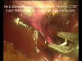 Laparoscopy Cholecystectomy Video (Keyhole / Lap Chole ) Laparoscopy Cholecystectomy Video (Keyhole / Lap Chole )
