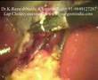Laparoscopy Cholecystectomy Video (Keyhole / Lap Chole )