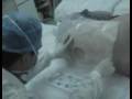 Stem-Cell-Injection-