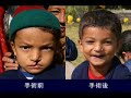 ADRA Japan ネパール口唇口蓋裂医療プロジェクト