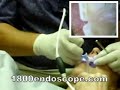 etime dental ehe dental cam pencam penscope procedure etime dental ehe dental cam pencam penscope procedure