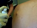 Cyst fest: The Slice'n'Squeeze