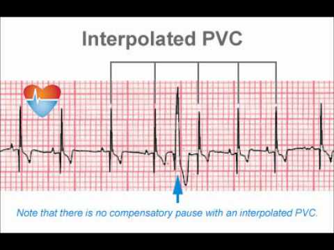 how to control pvc heart