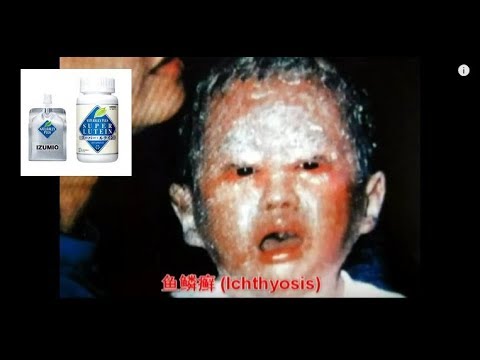 how to cure ichthyosis