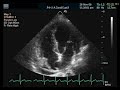 Inter-atrial septal aneurysm