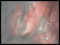 myomectomy