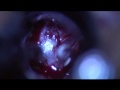 Transsphenoidal craniotomy