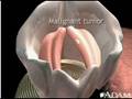 videos de Malignant tumor