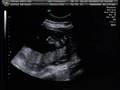 videos de Baby Ultrasound Week 26