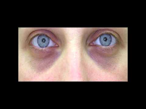 how to get rid of purple under eyes
