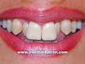 Est�tica dental: dientes detr�s de otros (problema/soluci�n)