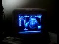 40 weeks ultrasound