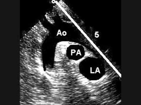 how to measure j point on ecg